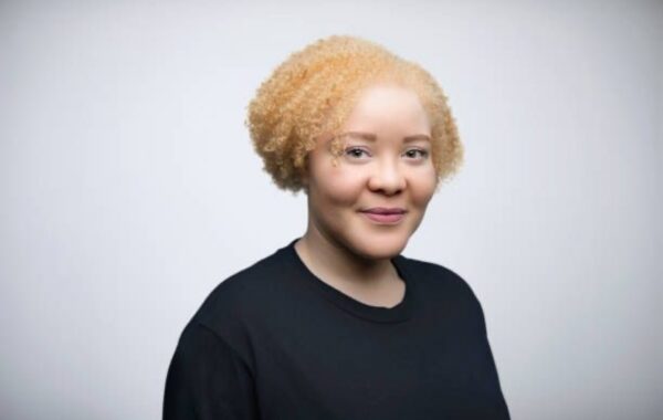 Entertainers with albinism who are an inspiration