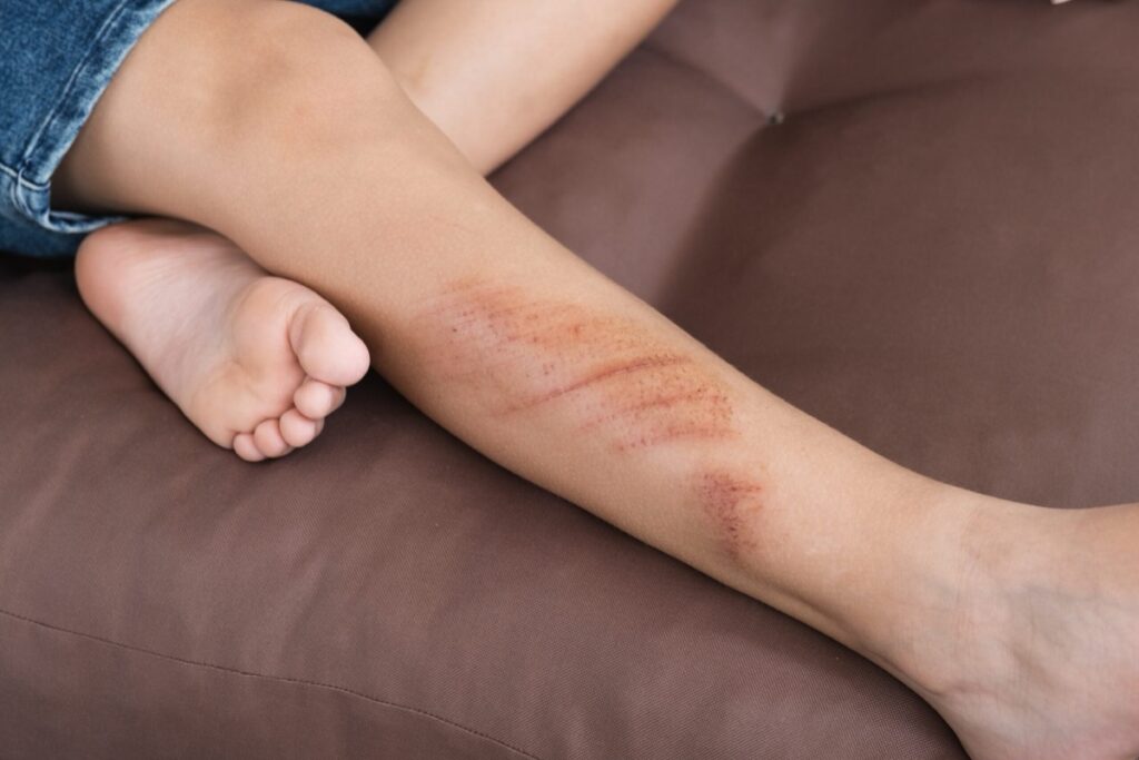 What’s Hot: Flabba’s alleged killer shows bruises and wounds