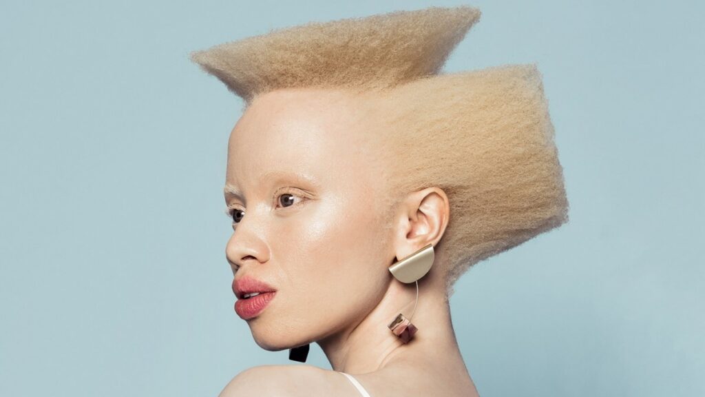Celebrating ZAlebs with Albinism
