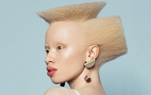 Celebrating ZAlebs with Albinism